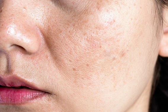 Fonte: sociedade brasileira de dermatologia