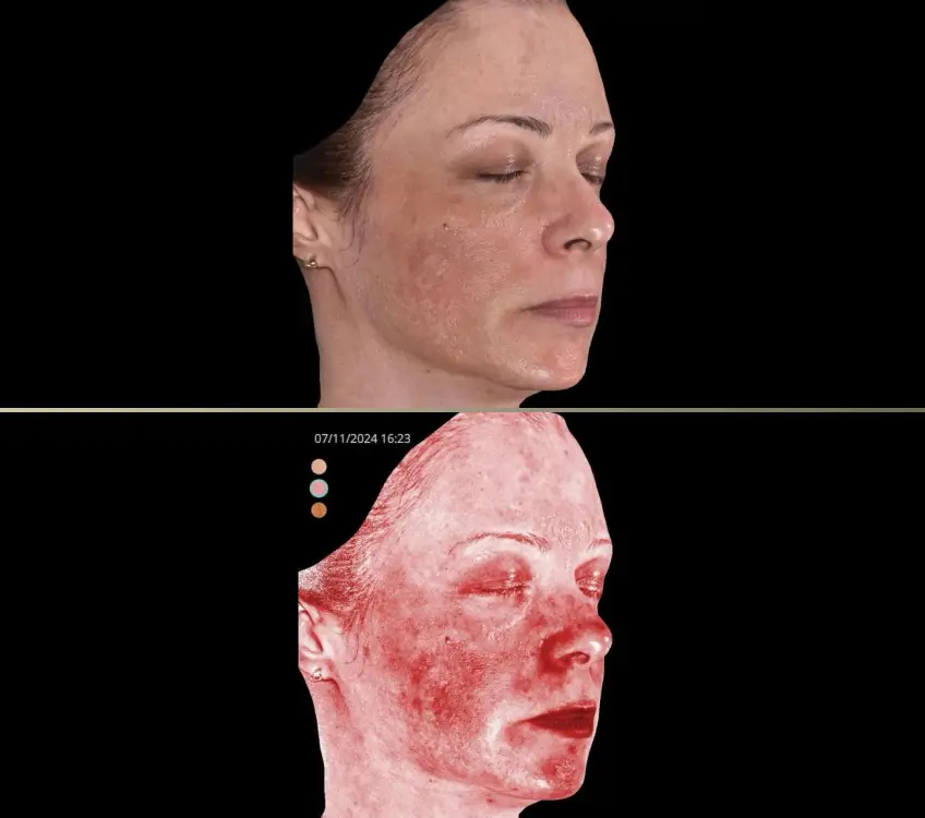 ANTES MELASMA 2 A ANTES MELASMA 2 A