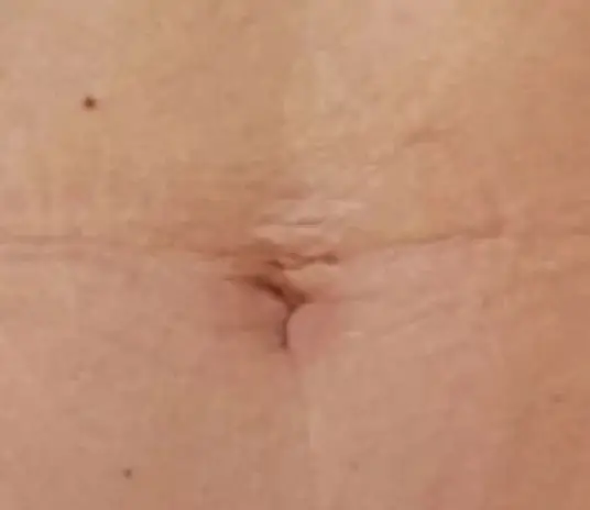 DEPOIS FLACIDEZ umbigo