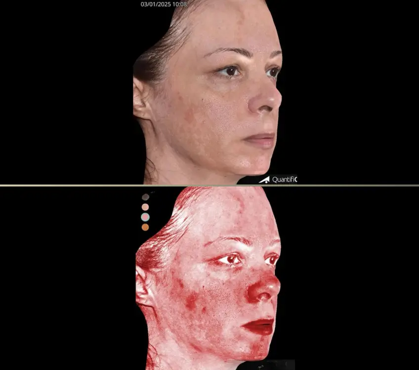 DEPOIS MELASMA 2 B