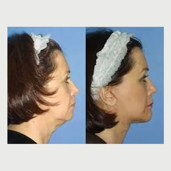 Antes e depois flacidez new 02