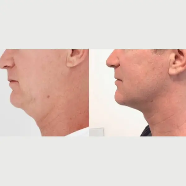 Antes e depois flacidez new 03